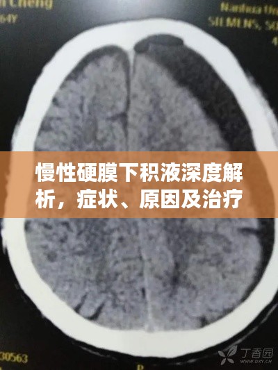 慢性硬膜下积液深度解析,症状、原因及治疗方法